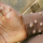 Here’s What You Need To Know About Monkeypox.